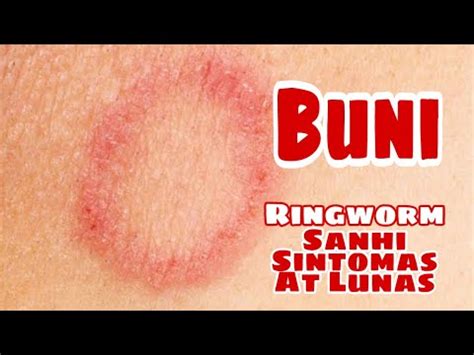 Buni (Ringworm) .